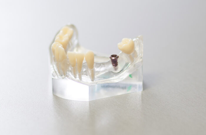 Zubní implantáty