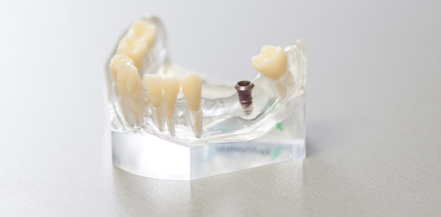 Zubní implantáty