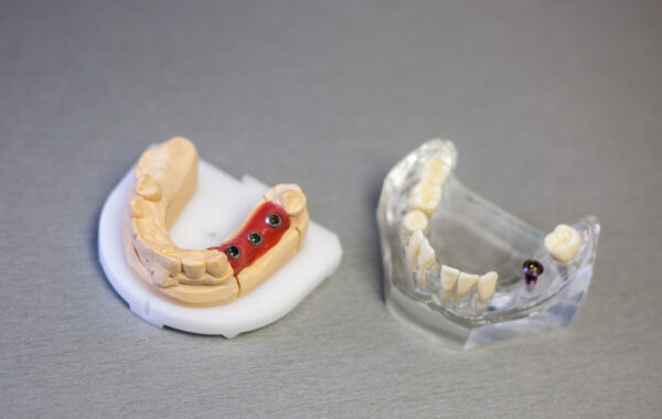 Protetika (zubní náhrady)